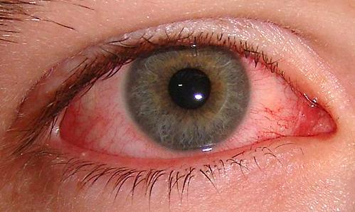 Alerjik göz nezlesi (alerjik konjonktivit)