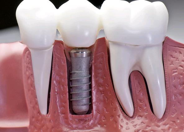 Türk dental implantı Maldivler’e gidiyor